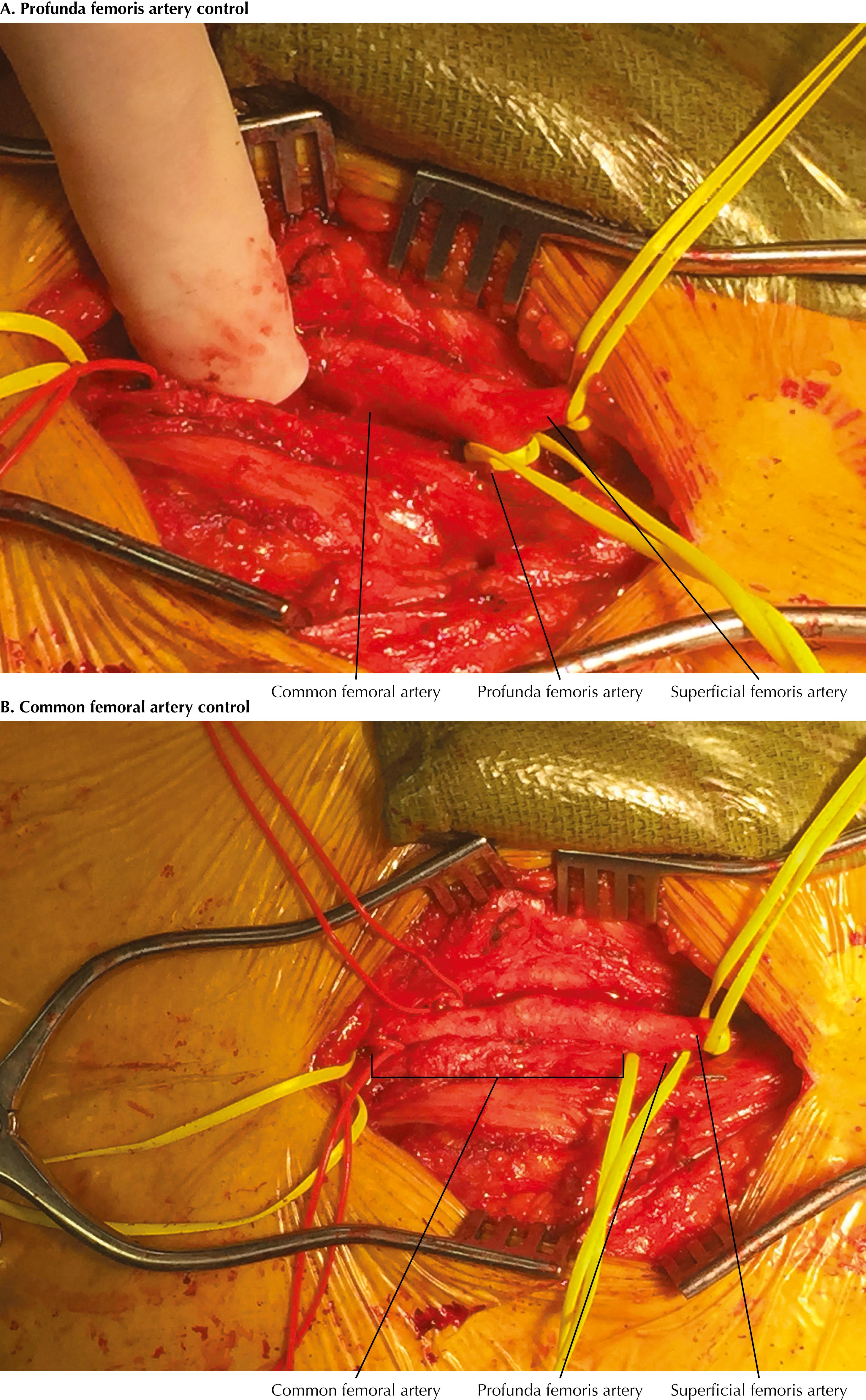 FIGURE 47.2, Profunda femoris artery control and common femoral artery control.