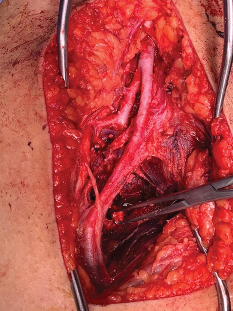 FIGURE 1, Multiple gunshot wounds to the right thigh with documented injury of the right femoral vein, which was ligated. Demonstrated here is the bifurcation of the profunda femoral artery and superficial femoral artery. Note the crossing lateral circumflex vein distal to the takeoff of the profunda femoral artery. The inguinal ligament is visible in the upper apex of the incision.