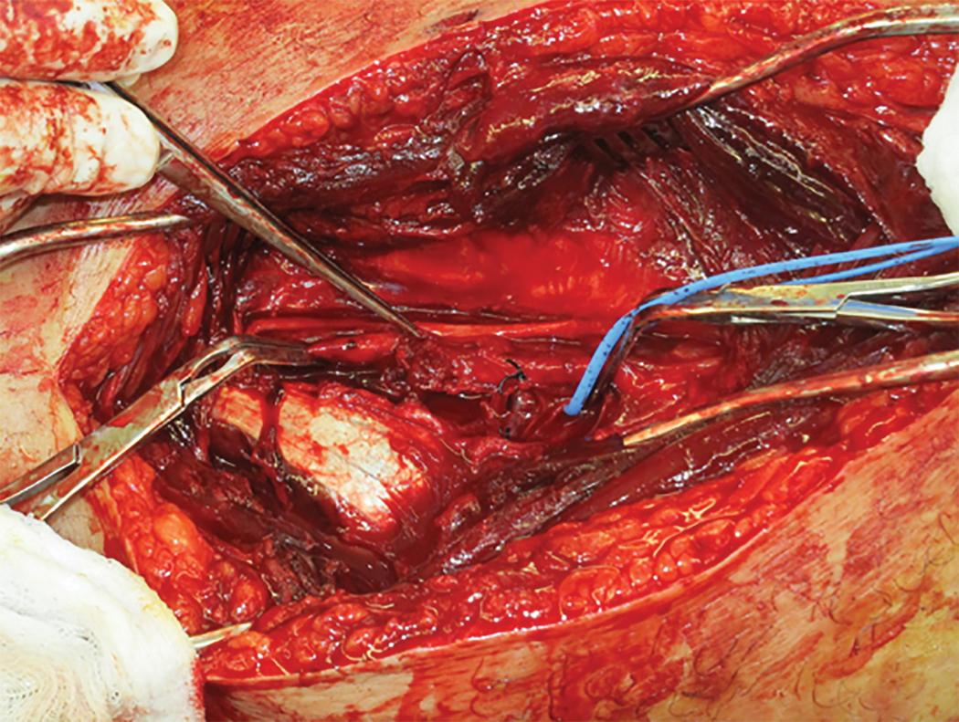 FIGURE 2, Superficial femoral artery injury due to a gunshot wound. Note the partial transection of the artery with subsequent thrombosis.