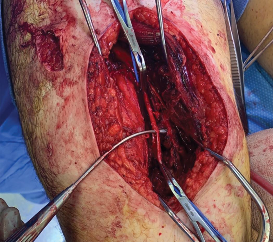 FIGURE 3, Stab wound with injury of both the superficial femoral artery and femoral vein.