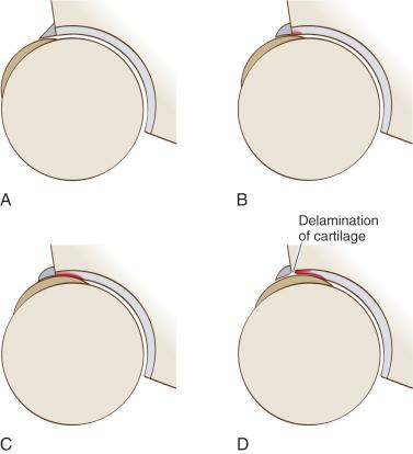 Fig. 31.2, (A – D) The cam mechanism. As the hip is flexed, a dynamic abnormal force on the acetabular cartilage starts at the labral-chondral junction.