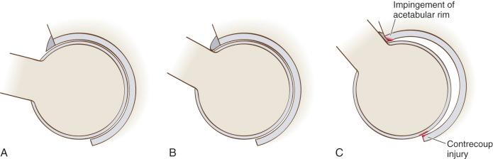 Fig. 31.3, (A–C) The pincer mechanism. As the hip is flexed, the femoral neck abuts the rim of the acetabulum. Direct injury to the labrum and rim cartilage is evident. A contrecoup injury to the posterior acetabular cartilage also may occur.