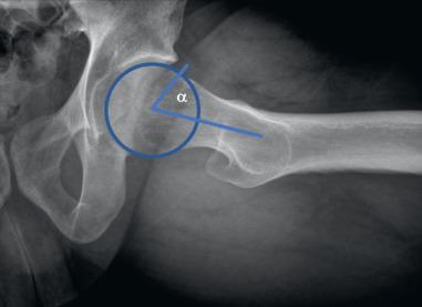 Fig. 80.13, A 90-degree Dunn lateral radiograph shows a patient with cam-type femoroacetabular impingement with depiction of the alpha angle. A circle is outlined over the femoral head, using the posterior aspect of the head to place the circle. The angle is drawn with the vertex at the center of the circle and one line down the femoral neck. The other line bisects the point where the femoral head-neck junction exits the round contour of the circle.