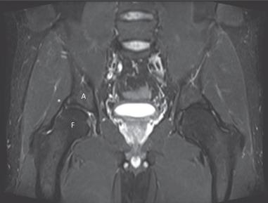 Fig. 80.14, A coronal fat-suppressed T2-weighted magnetic resonance image of the bilateral hips demonstrates an anterosuperior labral tear (*) at the right hip. The labral tear is visualized as a fluid cleft between the acetabular rim and the labral tissue. A , Acetabulum; F , femoral head.