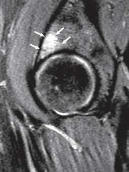 Fig. 80.15, A fat-suppressed, T2-weighted magnetic resonance image of the hip demonstrates subchondral edema (white arrows) in the acetabulum, indicative of insufficiency of the articular surface.