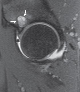 Fig. 80.16, A fat-suppressed, T2-weighted magnetic resonance image of the hip shows a subchondral cyst (white arrows) , which may be seen as the result of a chondrolabral injury.