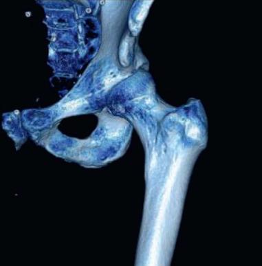 Fig. 80.17, A three-dimensional (3D) reconstruction from a computed tomography scan of a left hip. The 3D image is often used to better localize the bony impingement and determine surgical planning for precise cam resection.