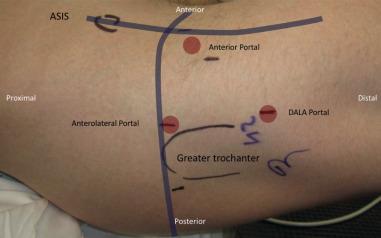 Fig. 80.19, Surface anatomy and preoperative skin markings are shown for a right hip prior to arthroscopy. The anterolateral, anterior, and distal anterolateral accessory (DALA) portals are shown in their typical locations relative to lines drawn in reference to the anterosuperior iliac spine (ASIS) and greater trochanter.