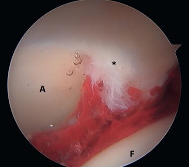 Fig. 80.20, An arthroscopic image is shown through the anterolateral viewing portal from a 70-degree arthroscope visualizing a typical anterosuperior labral tear (*). A , Acetabular cartilage; F , femoral head cartilage.