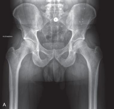 Fig. 80.6, A standard radiographic series is shown for the initial evaluation of a patient with potential femoroacetabular impingement. (A) A well-centered anteroposterior view, (B) a 90-degree Dunn lateral, and (C) a false-profile view.