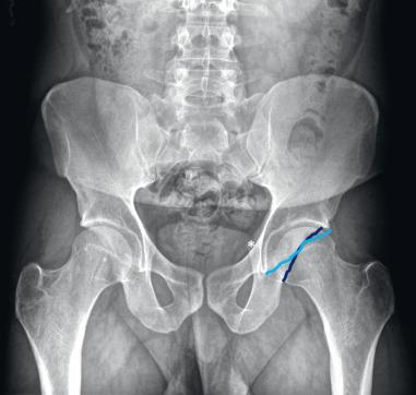Fig. 80.7, An anteroposterior radiograph is shown with multiple features of acetabular overcoverage, including a prominent ischial tuberosity (*) and a crossover sign. The anterior acetabular wall is outlined in light blue and the posterior wall is outlined in dark blue , with a crossover present near the center of the femoral head, indicating relative retroversion.