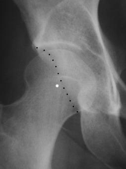 Fig. 80.8, The posterior wall sign is demonstrated on the radiograph of a patient with acetabular impingement. The posterior wall is located medial to the center of the femoral head.