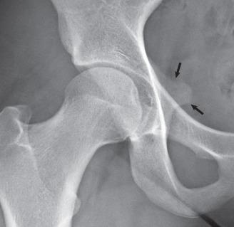 Fig. 80.9, A prominent ischial spine sign is seen on an anteroposterior radiograph of the right hip (black arrows) , which is suggestive of acetabular retroversion.