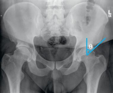 Fig. 80.12, An anteroposterior radiograph is shown for a patient with mixed-type femoroacetabular impingement and increased lateral overcoverage of the acetabulum. The lateral center-edge angle is measured with the vertex at the center of the femoral head. The vertical limb is perpendicular to a horizontal line across the base of the ischium of teardrops and the second limb across the lateral aspect of the acetabulum.