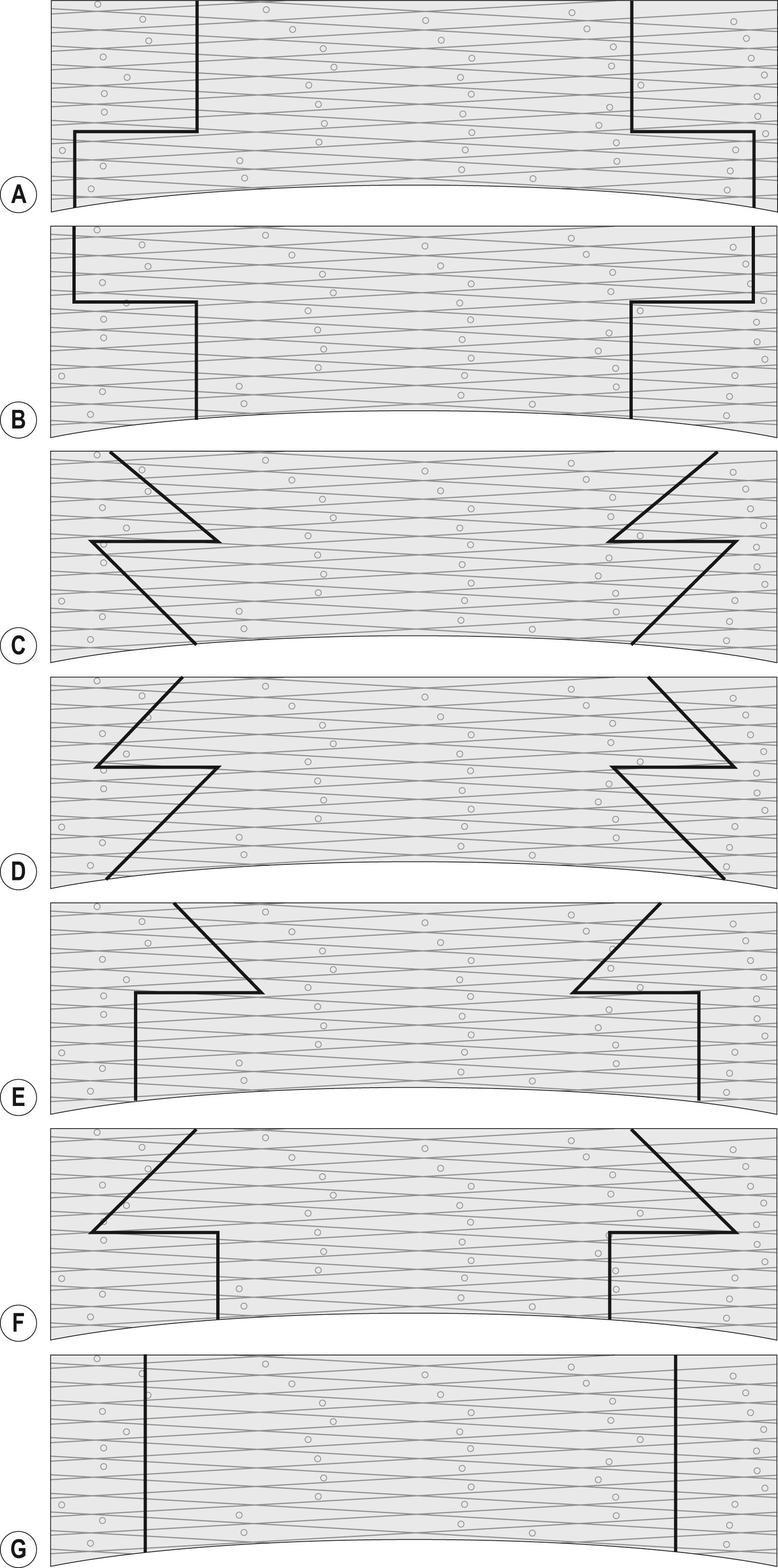 Fig. 113.1, ( A ) Schematic of “Top-hat” incision. ( B ) Schematic of “Mushroom” incision. ( C ) Schematic of “Zig-zag” incision. ( D ) Schematic of “Christmas tree” incision. ( E ) Schematic of “Zig-square” incision. ( F ) Schematic of “Anvil” incision. ( G ) Schematic of “Traditional” incision.