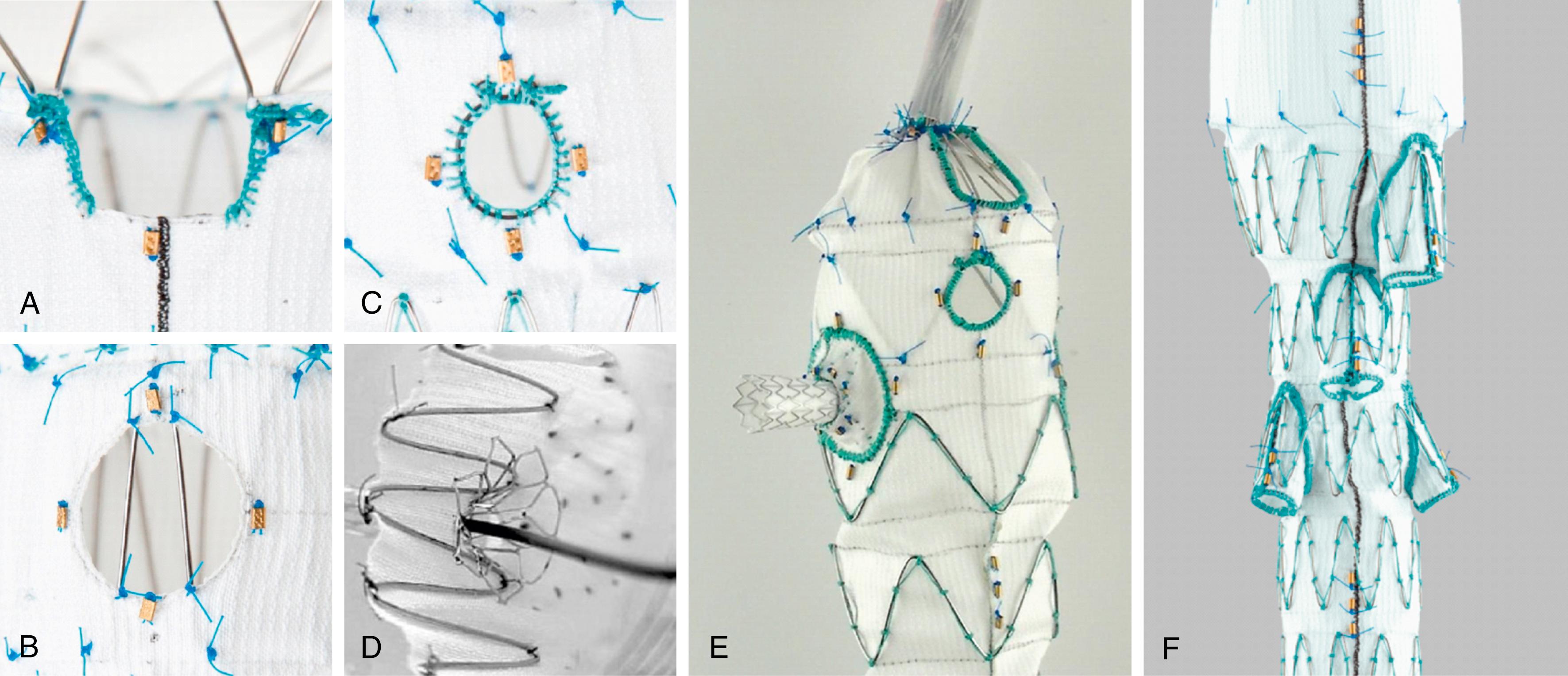 Figure 82.1, Illustrations of ( A ) scallop, ( B ) fenestration, ( C ) reinforced fenestration, ( D ) fenestration supported with a flared, bare-metal stent, ( E ) pivot fenestration supported with a covered balloon-expandable covered stent, and ( F ) side arm branch, as defined by the SVS Reporting Standards for Endovascular Repair of Aneurysms Involving the Renal–Mesenteric Arteries.