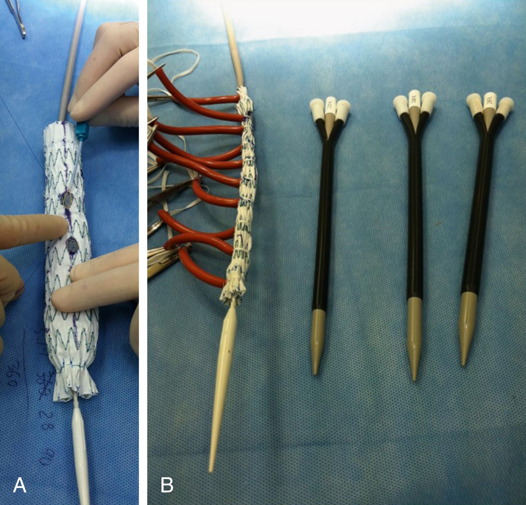 Figure 82.2, Visceral artery branched devices, showing both straight cuffs ( A ) and helical branches ( B ).