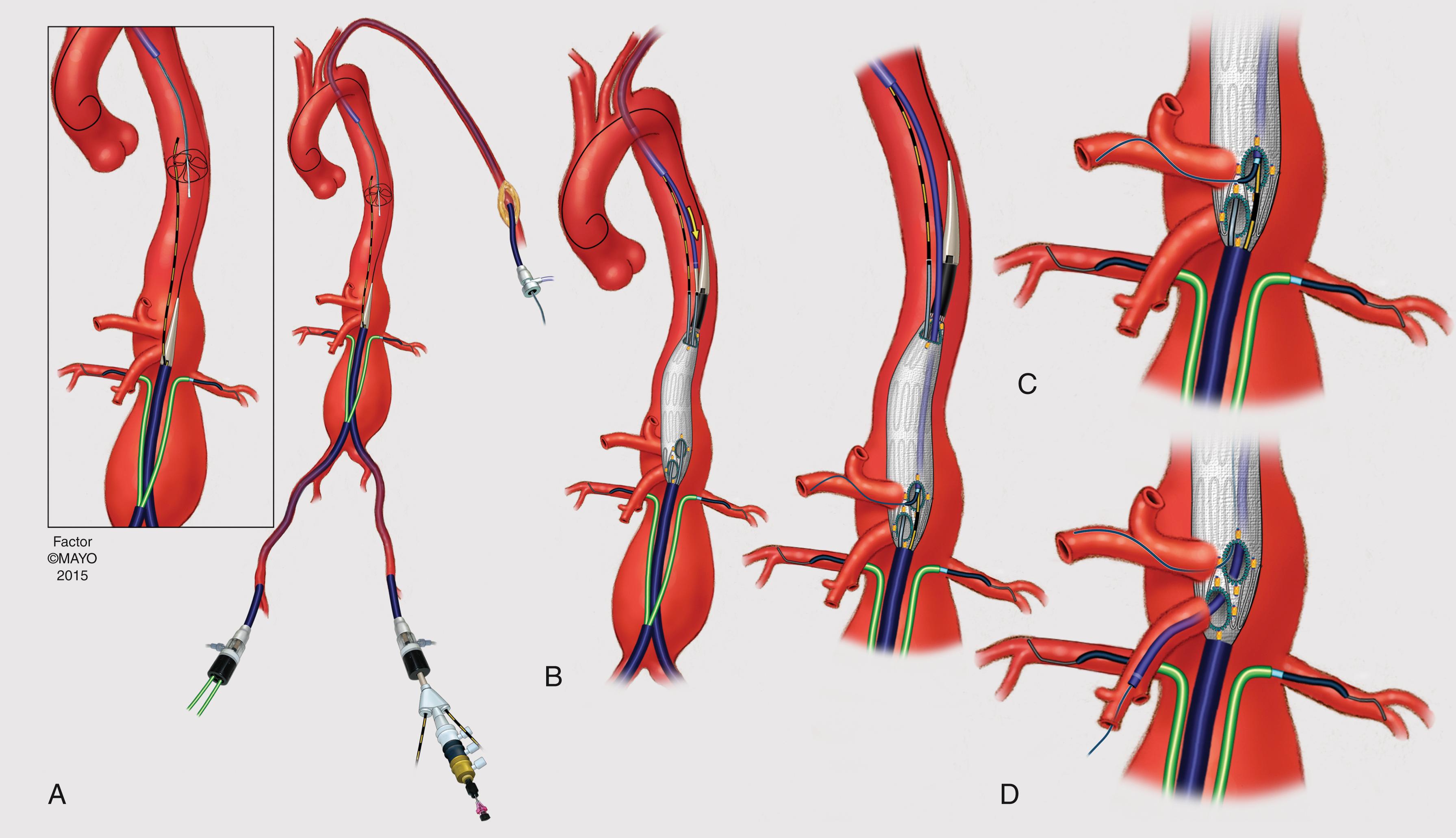 Figure 82.5, Demonstration of the Use of Preloaded Catheters During Fenestrated and Branched Endovascular Aortic Aneurysm Repair.