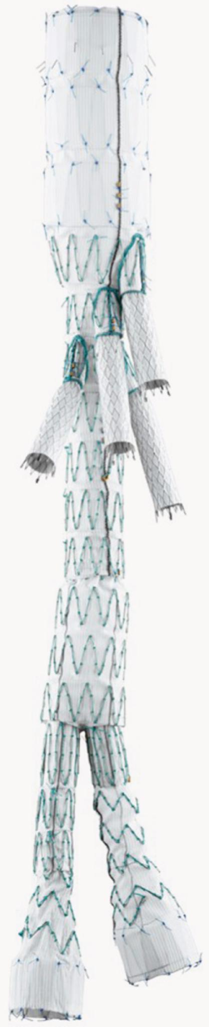 Figure 82.7, The Thoracic Branched (“t-Branch”) device (Cook Medical, Inc., Bloomington, IN), an off-the-shelf endograft system designed for repair of thoracoabdominal aortic aneurysms.