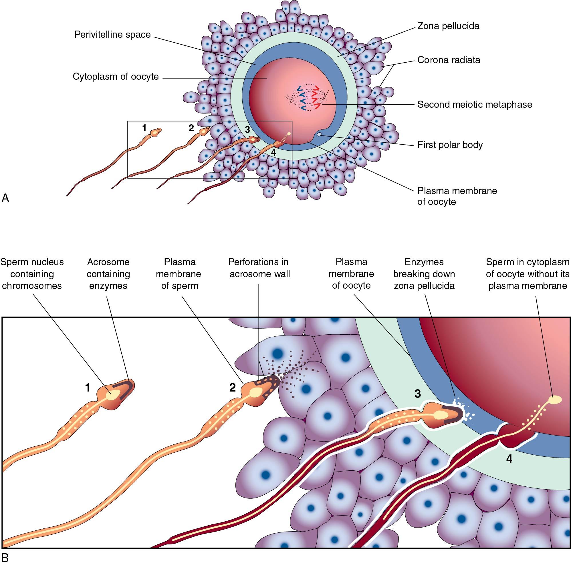 Fig. 1.6, Acrosome reaction and a sperm penetrating an oocyte. The detail of the area outlined in A is given in B . 1, Sperm during capacitation, a period of conditioning that occurs in the female reproductive tract. 2, Sperm undergoing the acrosome reaction, during which perforations form in the acrosome. 3, Sperm digesting a path through the zona pellucida by the action of enzymes released from the acrosome. 4, Sperm after entering the cytoplasm of the oocyte. Note that the plasma membranes of the sperm and oocyte have fused and that the head and tail of the sperm enter the oocyte, leaving the sperm’s plasma membrane attached to the oocyte’s plasma membrane.