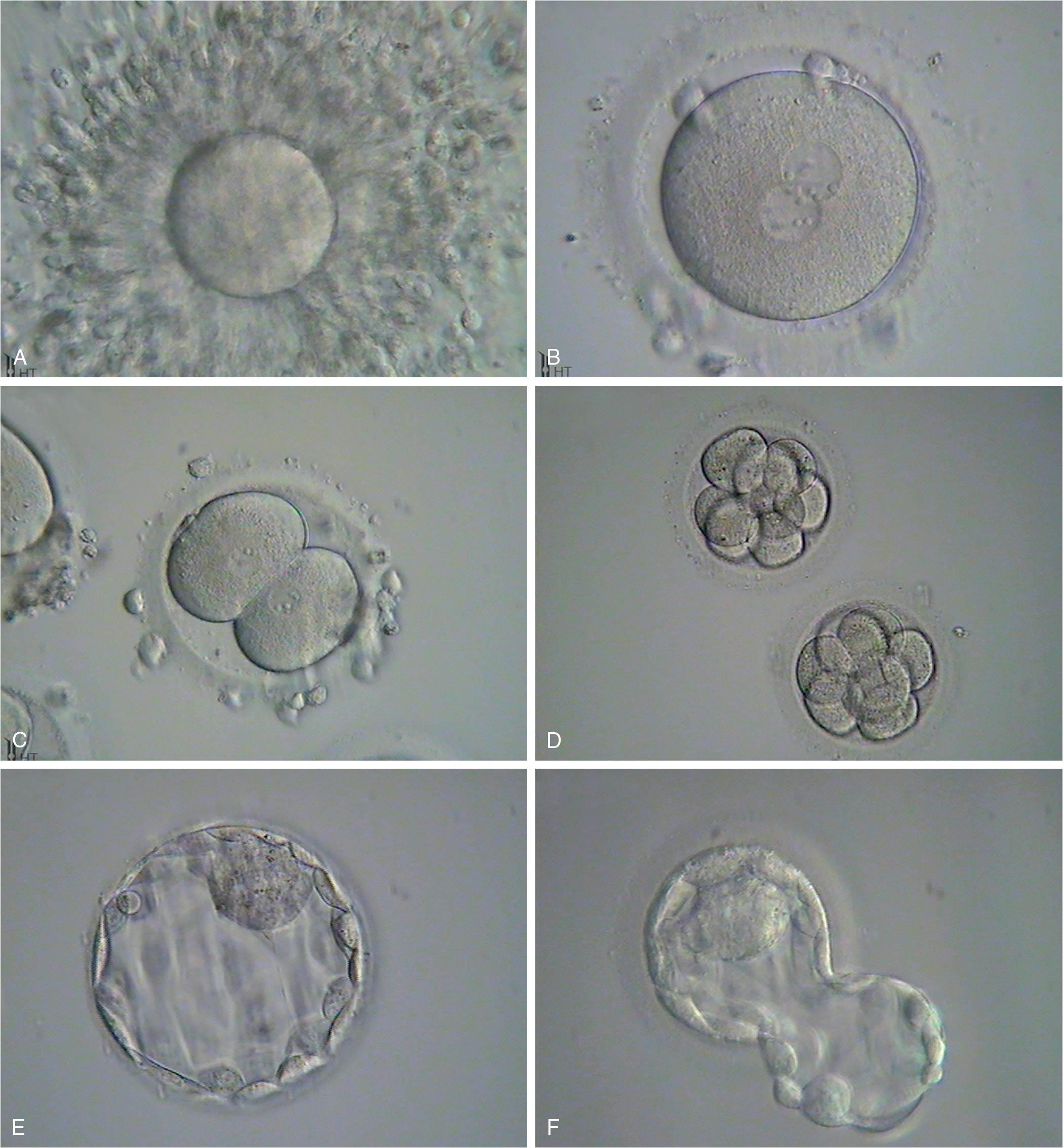 Fig. 1.7, Six photomicrographs of fresh, unmounted human eggs and embryos. A, Recently retrieved human oocyte surrounded by cumulus cells. B, Fertilized oocyte demonstrating male and female pronuclei and both polar bodies at approximately 11 and 12 o’clock position. C, Two-cell zygote with scattered cumulus cells remaining attached to the zone pellucida. D, Eight-cell zygotes. E, Blastocyst with the inner cell mass seen at 12 o’clock. F, A hatching blastocyst in which a portion of the trophectoderm has extruded from the zona pellucida at the 4 o’clock position.