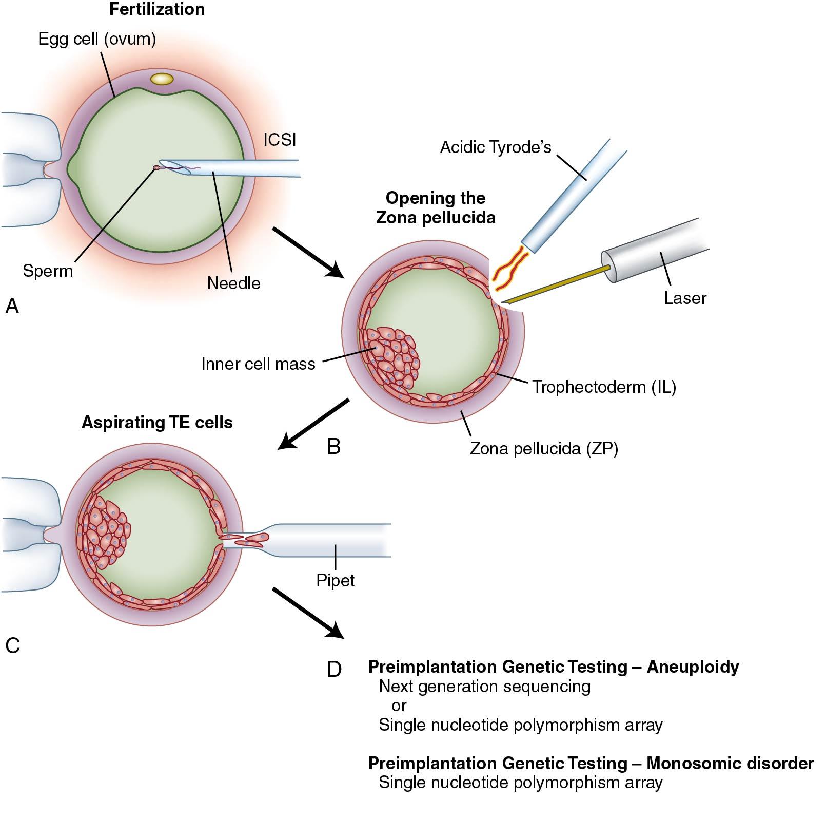 Fig. 1.8, Schematic of preimplantation testing. A, Commonly the oocyte is fertilized with a single sperm using the technique of intracytoplasmic sperm injection (ICSI). This precludes the possibility of contamination from sperm remaining attached to the outside of the embryo during embryo biopsy. B, On day 3 of culture, when the embryo has cleaved to about eight cells, a small opening is made in the zona pellucida (ZP) with either a laser or through brief exposure to an acid solution. C, By day 5 of culture the embryo has progressed to the blastocyst stage and a portion of the trophectoderm (TE) cells have prolapsed out the opening in the ZP. These cells are removed for subsequent DNA isolation. D, DNA from TE cells is used to determine chromosome number and insertions and deletions for preimplantation genetic screening using techniques of array comparative genomic hybridization or next generation sequencing. DNA may also be used to detect single-gene abnormalities for different diseases using single nucleotide polymorphism microarray or polymerase chain reaction amplification in the process of preimplantation genetic diagnosis.