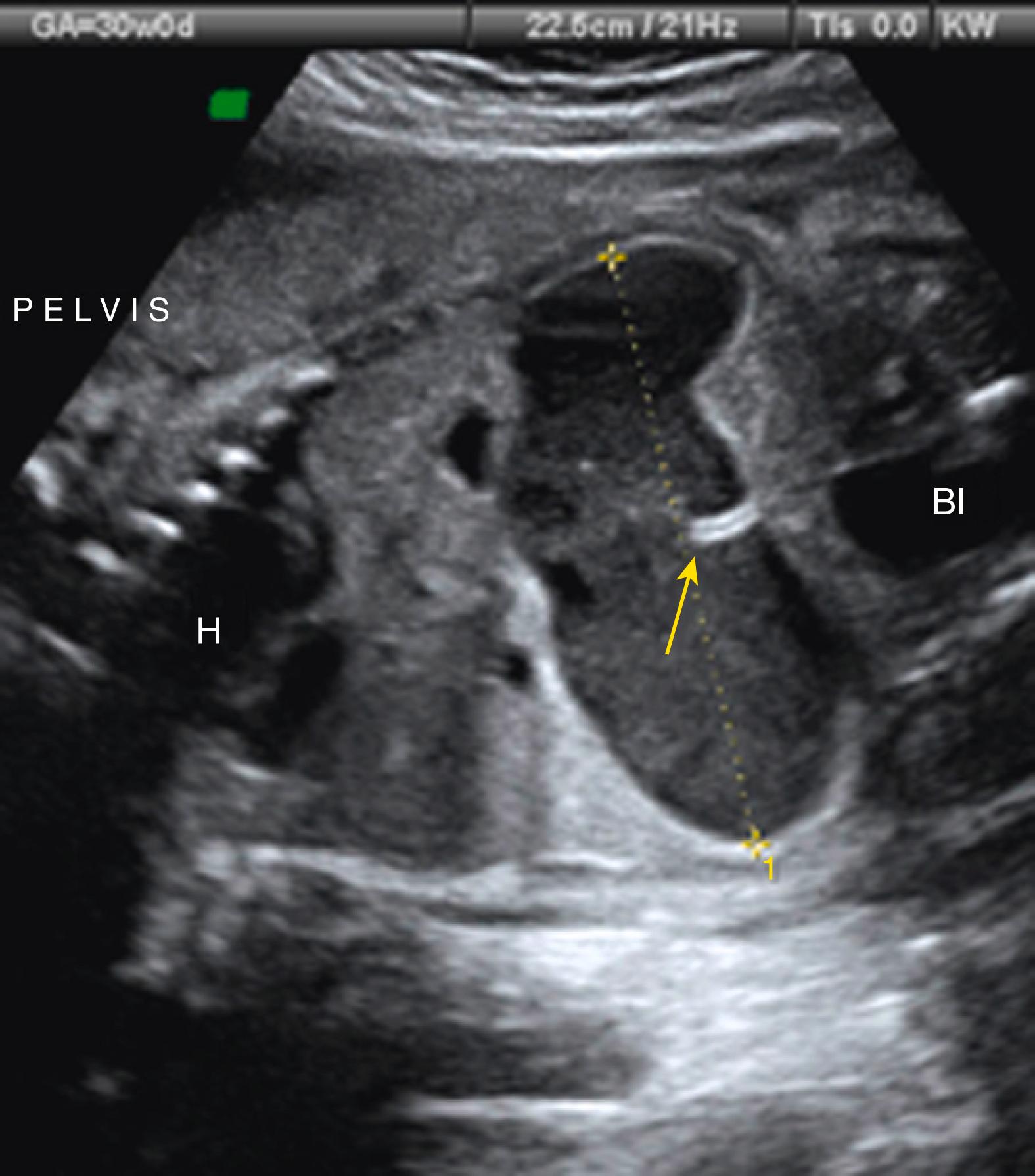 Figure 24.11, Colonic atresia.