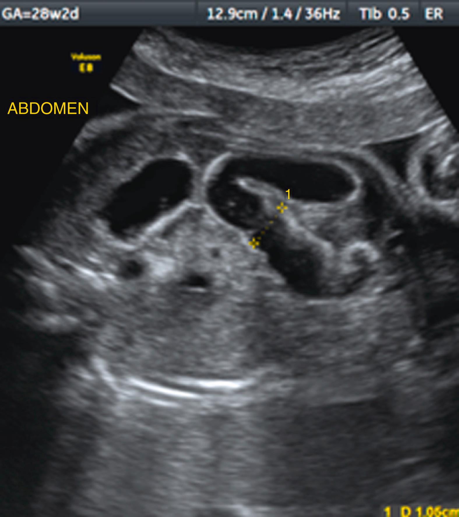 Figure 24.14, Anorectal atresia.