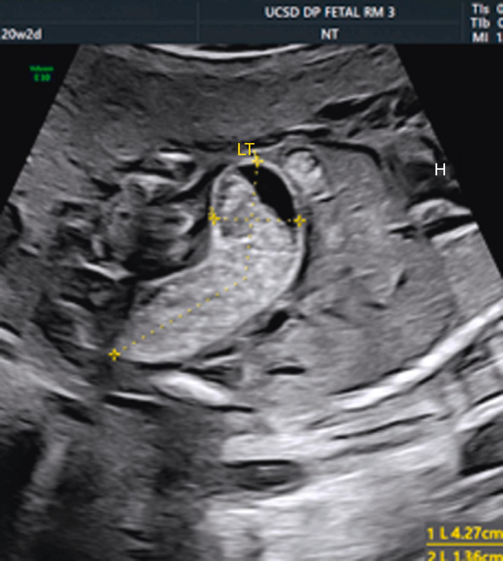 Figure 24.15, Imperforate anus.