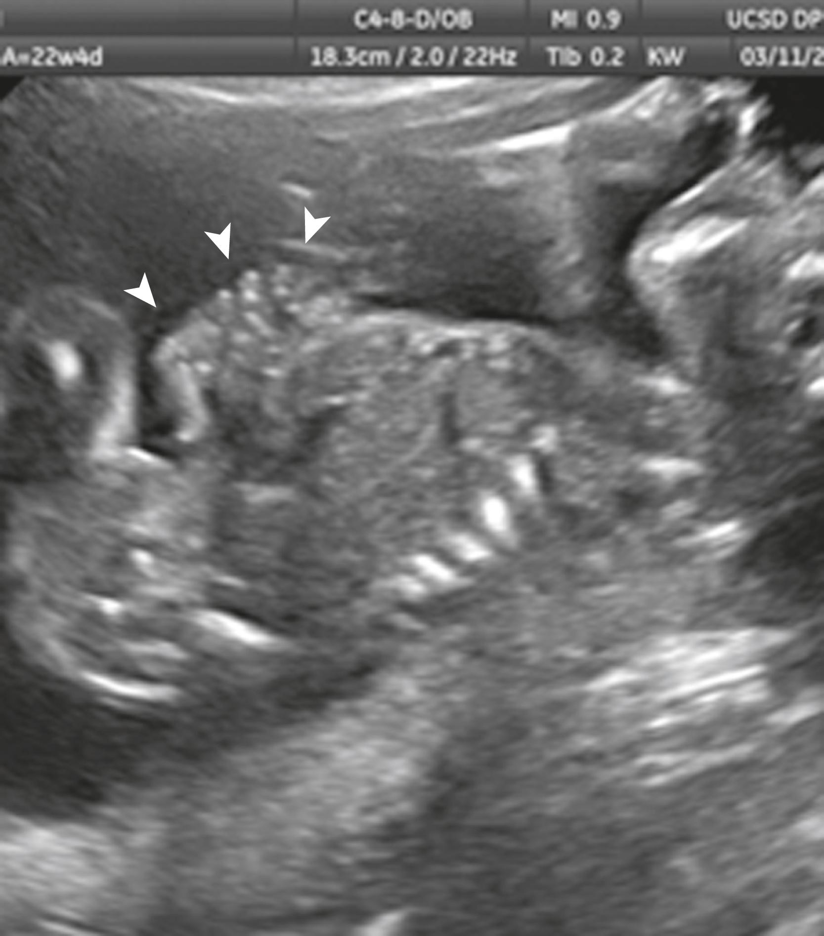 Figure 24.17, Gastroschisis.