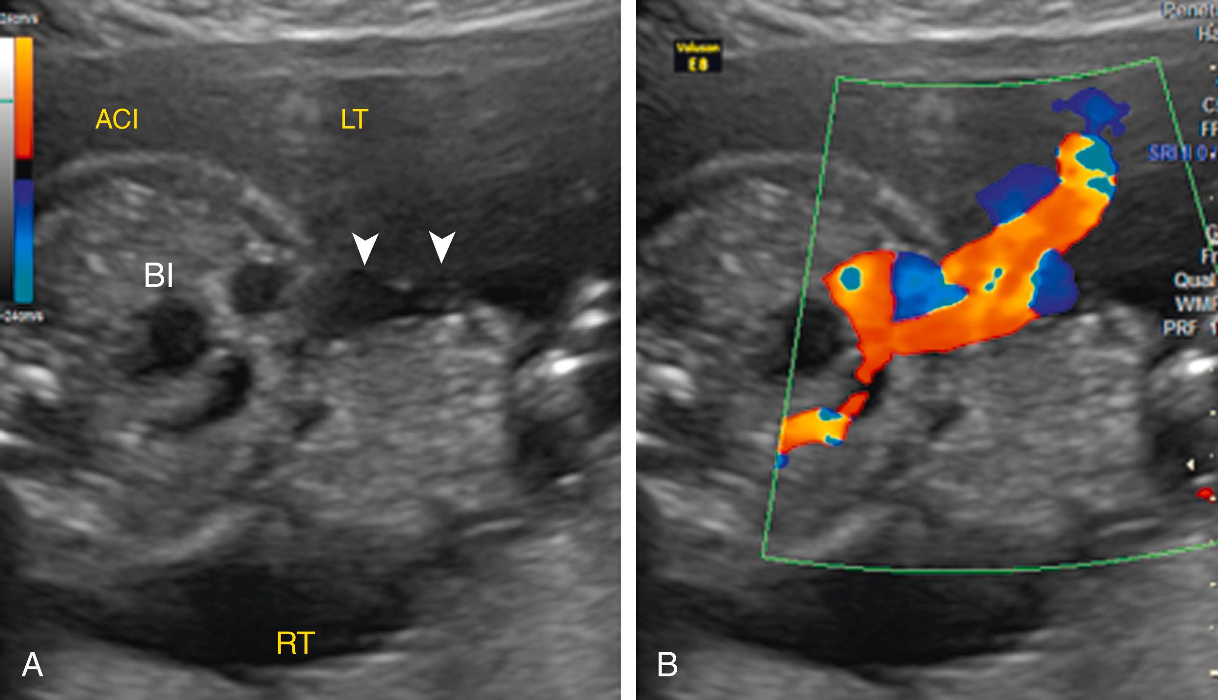 Figure 24.19, Gastroschisis.