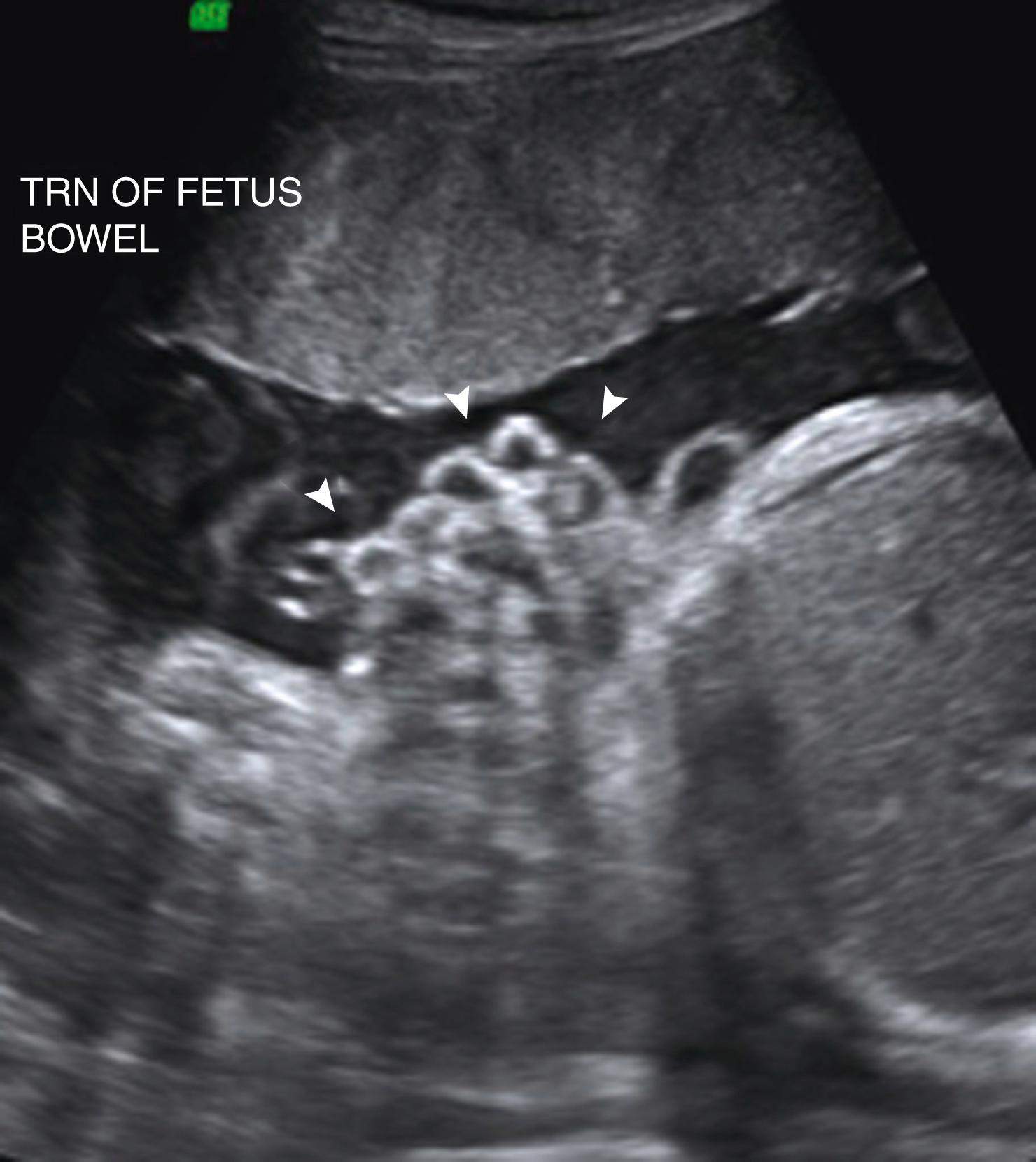 Figure 24.20, Gastroschisis with dilated extracorporeal bowel.