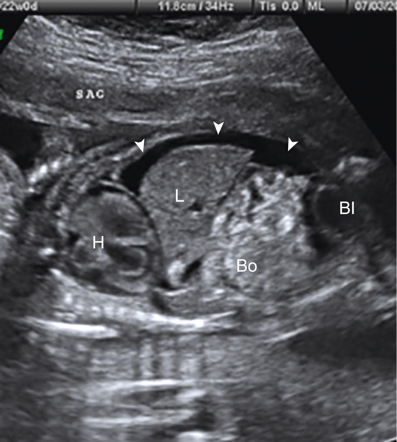 Figure 24.2, Ascites.