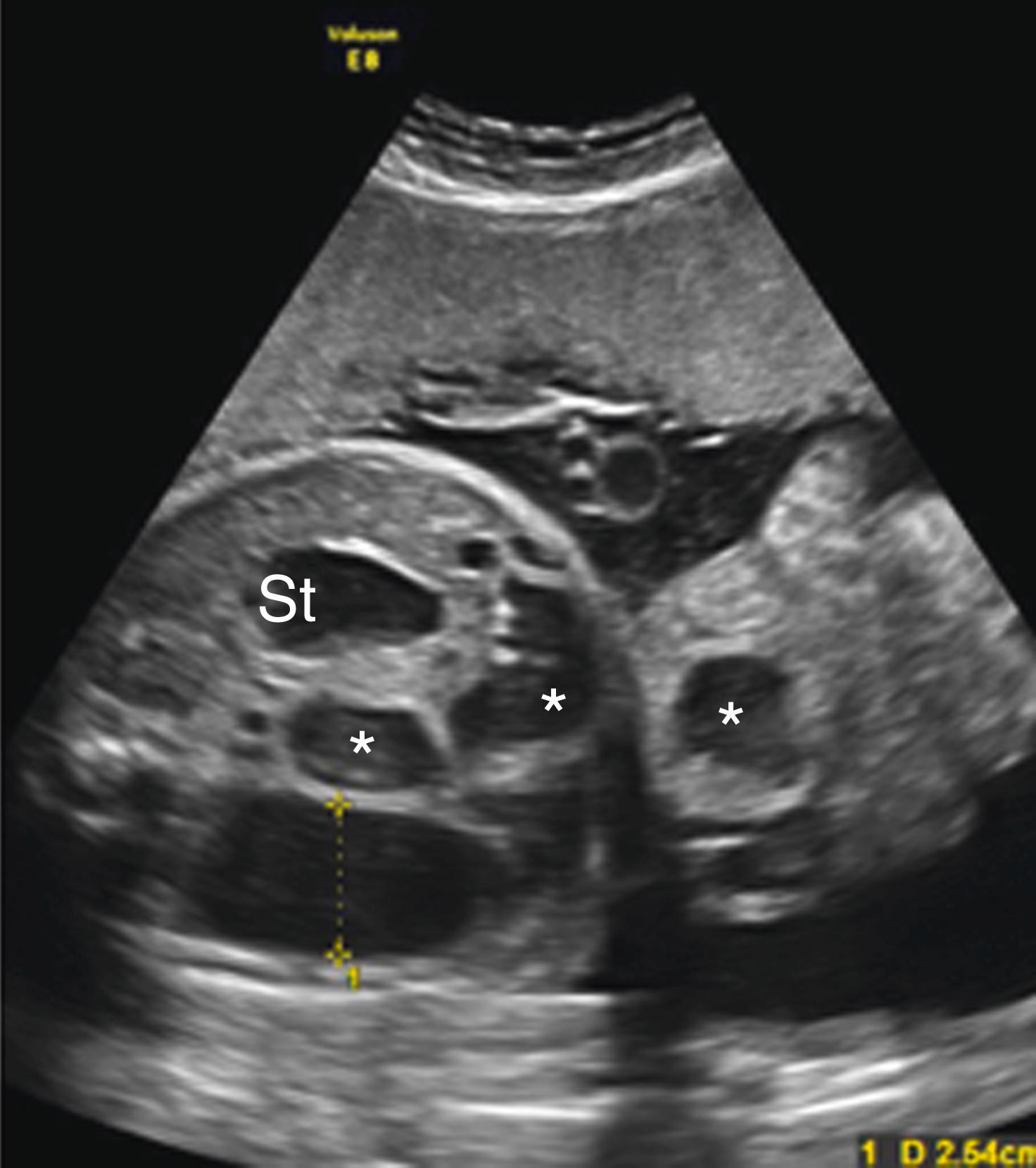 Figure 24.21, Markedly dilated bowel with gastroschisis.