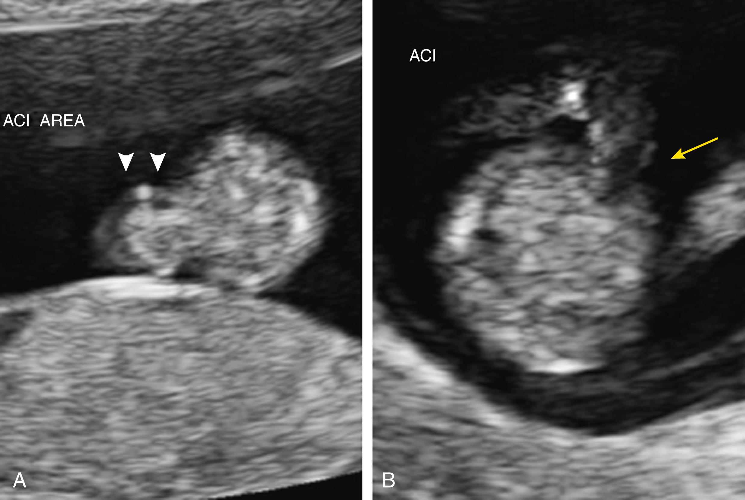 Figure 24.22, Physiologic gut herniation.