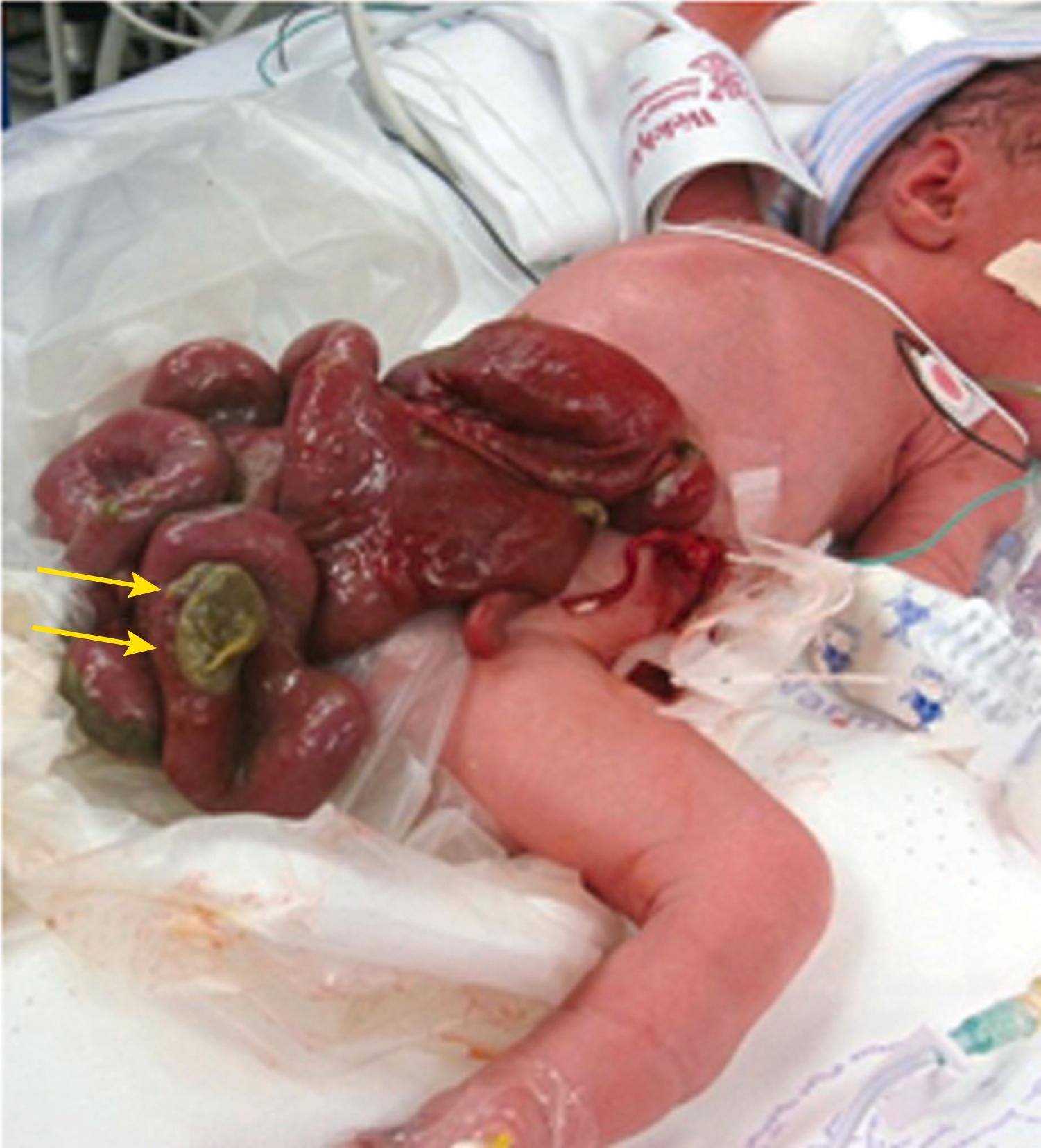 Figure 24.24, Neonatal appearance of gastroschisis.