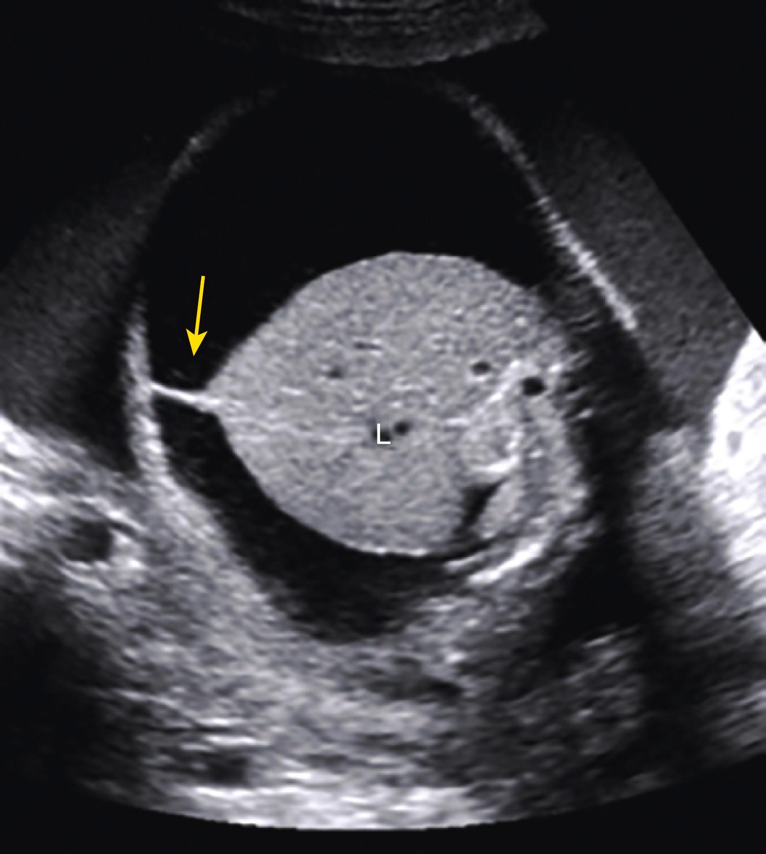 Figure 24.4, Extreme ascites.