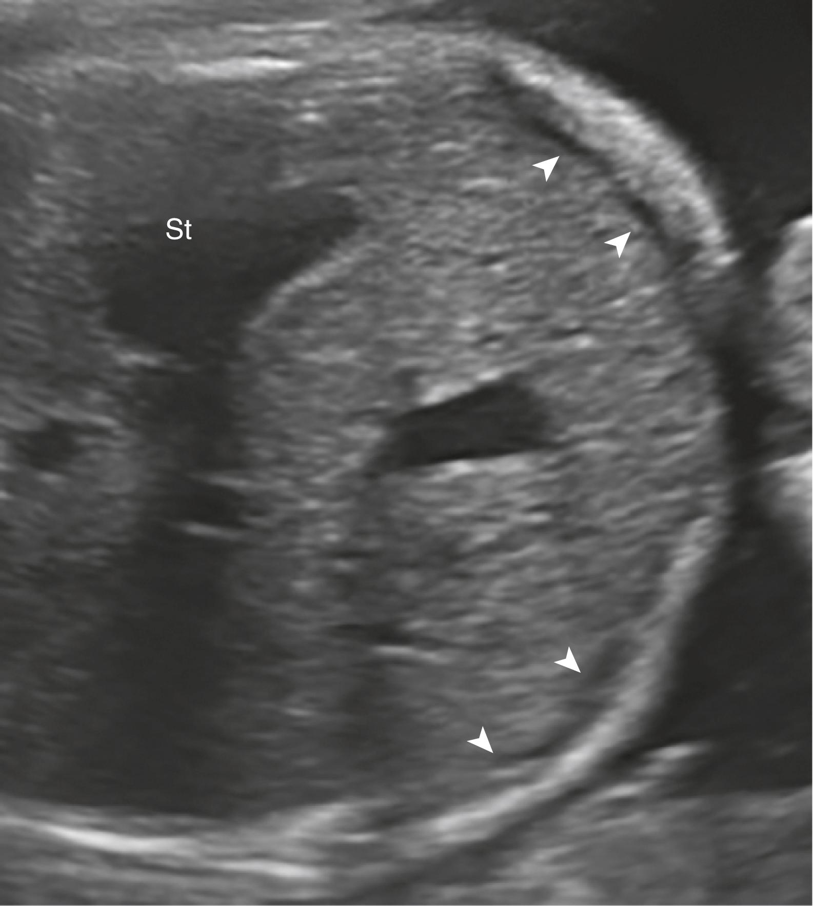 Figure 24.5, Pseudoascites, abdominal wall muscle.