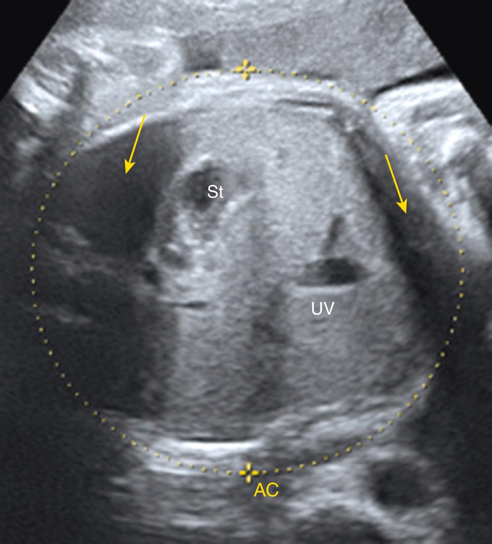 Figure 24.6, Pseudoascites, acoustic shadowing.