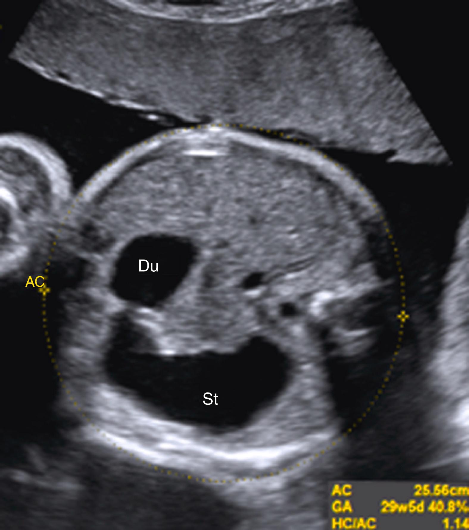 Figure 24.8, Distended stomach (St) with duodenal atresia.