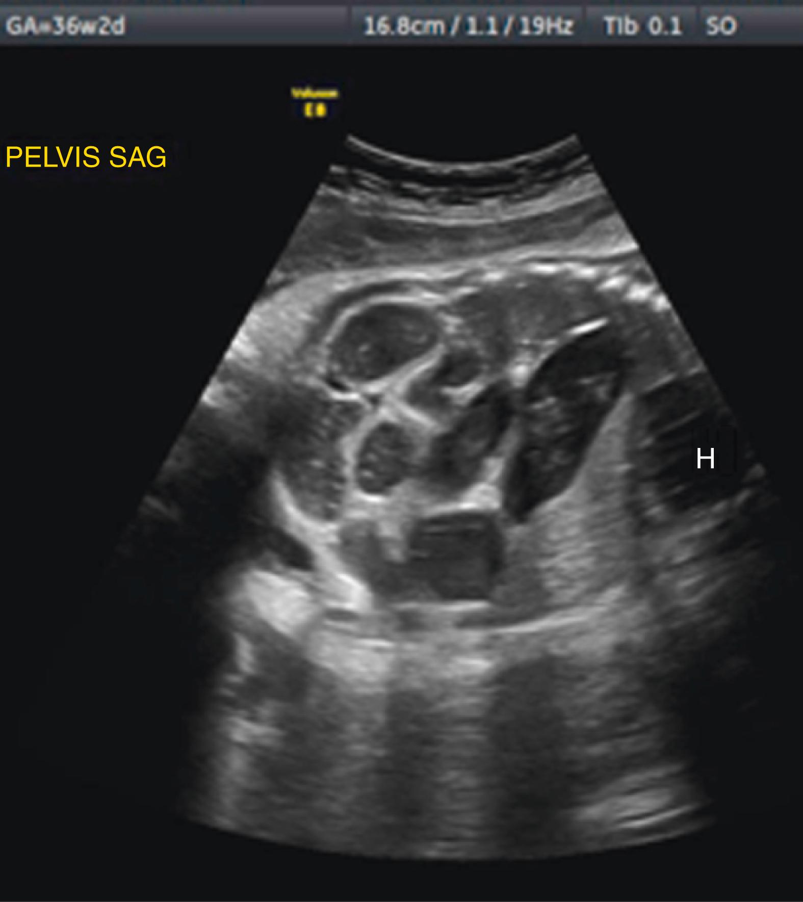 Figure 24.9, Jejunal atresia.