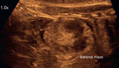 Fig. 17.2, Fetal adrenal mass, suspicious for neuroblastoma.