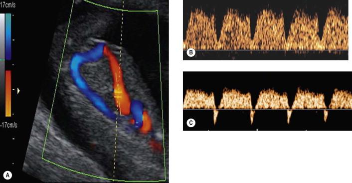 FIGURE 2-4, Mid-sagittal view of the fetal trunk demonstrating insonation of the ductus venosus (A) of a fetus at 12 weeks with normal waveform (B) and reversed a-wave (C).