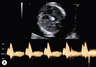 FIGURE 2-5, Transverse view of the fetal heart demonstrating Doppler assessment of flow across the tricuspid valve of a fetus at 12 weeks with normal waveform (A) and tricuspid regurgitation (B).