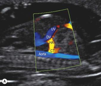 FIGURE 2-6, (A) Right ventral mid-sagittal view of a fetus at 12 weeks demonstrating the umbilical vein (UV), ductus venosus (DV), descending aorta, hepatic artery (HA) and coeliac trunk (CT). The peak systolic velocity in the waveform from the fetus with trisomy 21 (C) is much higher than in a euploid fetus (B).