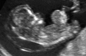 FIGURE 2-8, Sagittal view of the fetus at 12 weeks demonstrating exomphalos containing liver and bowel.