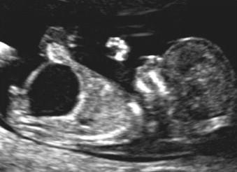 FIGURE 2-9, Sagittal view of the fetus with megacystis at 12 weeks.
