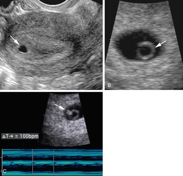 FIG 6-1, Early first trimester dating with sonographic milestones. A, Sagittal image showing a small rounded intrauterine fluid collection ( arrow ) in the central portion of the uterus, consistent with 5.0 weeks' gestation. B, Intrauterine gestational sac containing a yolk sac ( arrow ), consistent with 5.5 weeks' gestation. C, Intrauterine gestational sac containing a small embryo with heartbeat ( arrow ) adjacent to the yolk sac. M-mode tracing through the embryo documents a heart rate of 100 beats per minute. These findings are consistent with gestational age of 6.0 weeks.