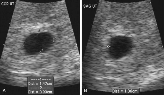 FIG 6-2, Mean sac diameter in early pregnancy. A, Coronal image of intrauterine gestational sac measuring approximately 15 mm in transverse diameter and 9 mm in anteroposterior diameter ( calipers ). B, Longitudinal view of gestational sac with sagittal measurement of approximately 11 mm. The mean sac diameter of this pregnancy is 12 mm.