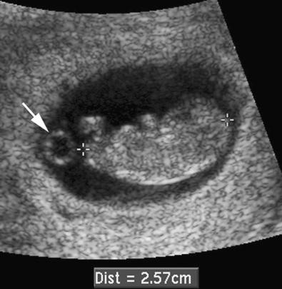 FIG 6-3, Crown-rump length measurement. Sonogram of fetus in gestation sac with crown-rump length measured ( calipers ). The yolk sac ( arrow ) is visible adjacent to the fetus, not included in the crown-rump length measurement